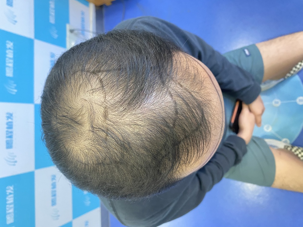 生理性vs病理性脫髮