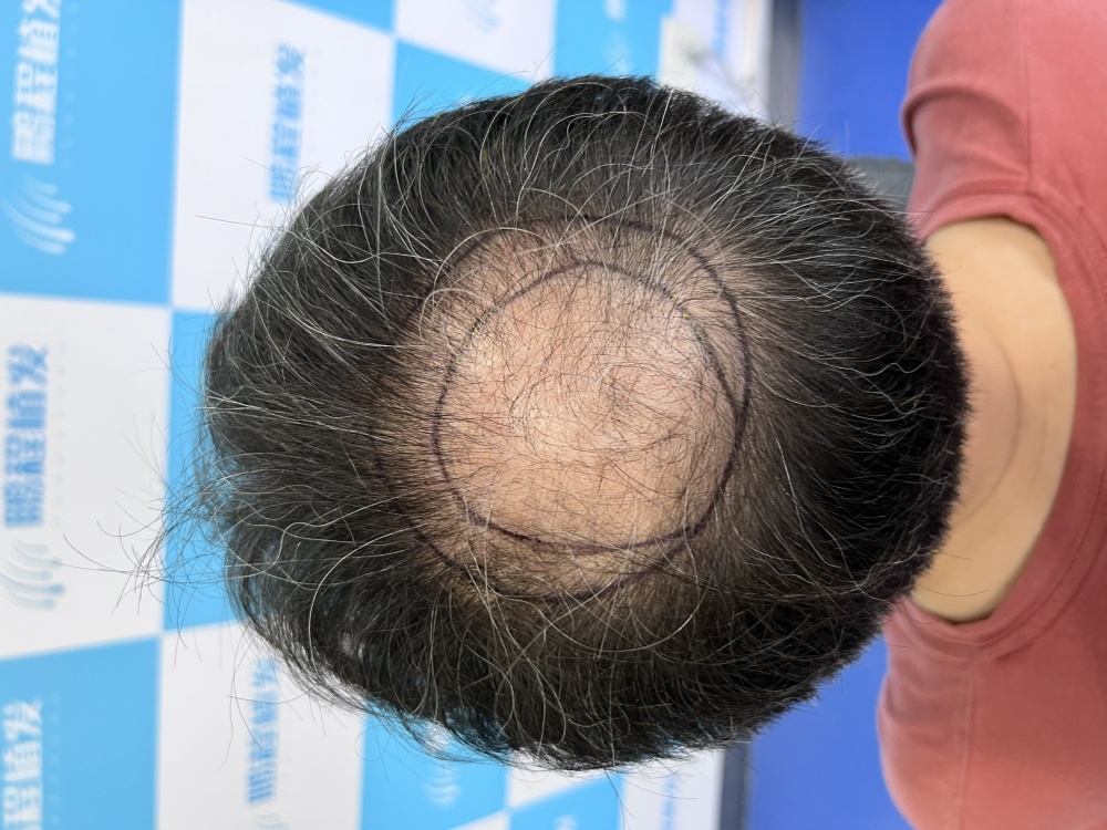 點樣分清「正常代謝掉髮」同「病理性脫髮」