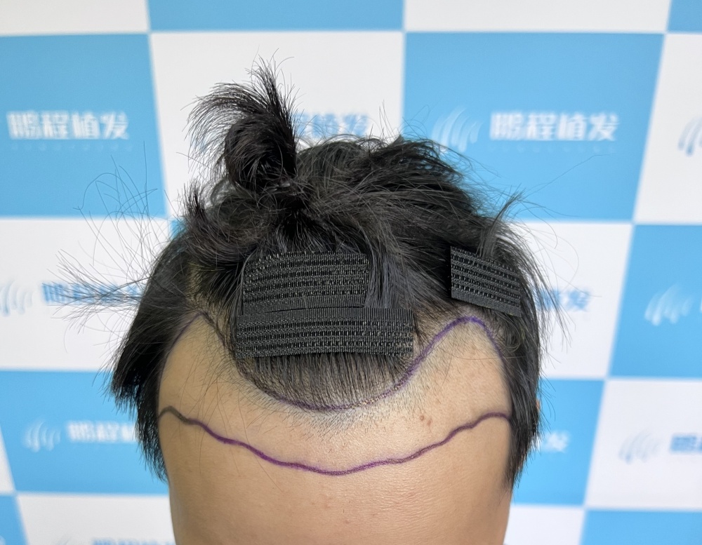 髮線後移點算好