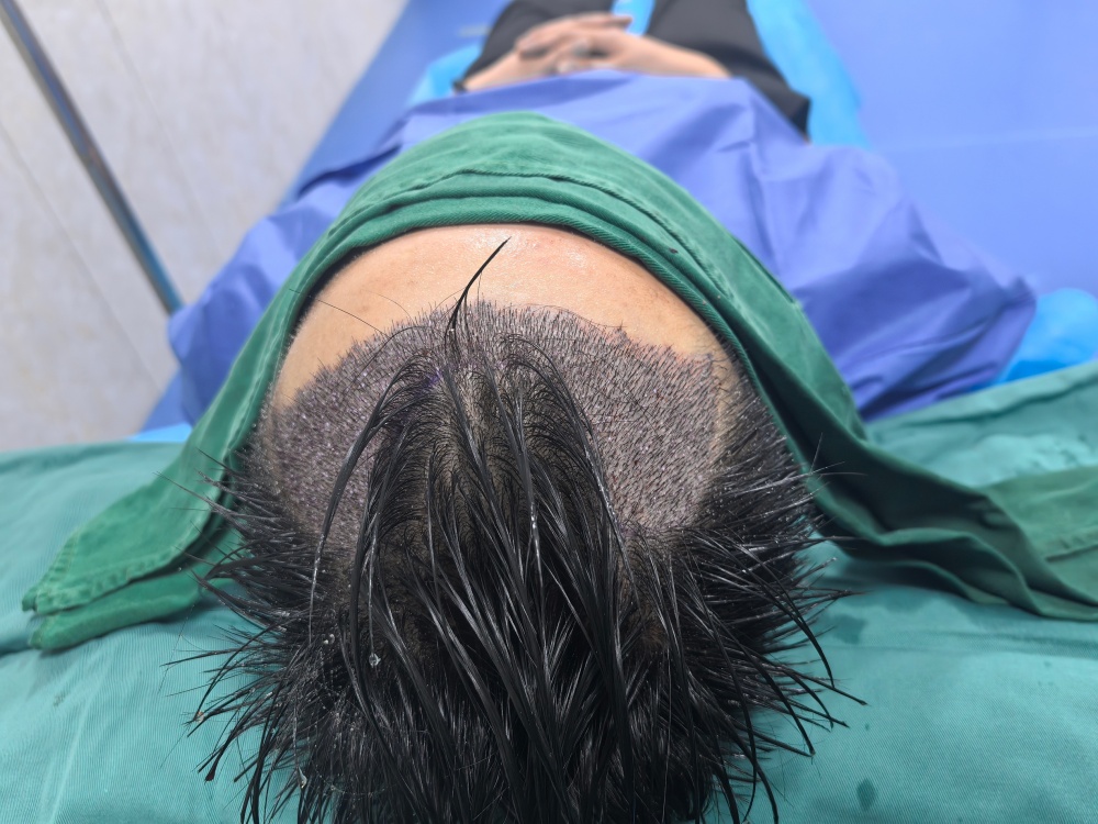 五一小長假植髮