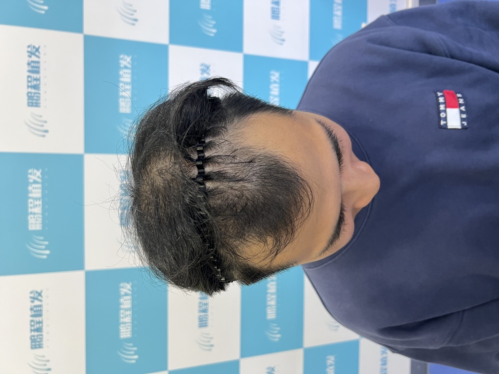 脫髮點解越來越年輕化？