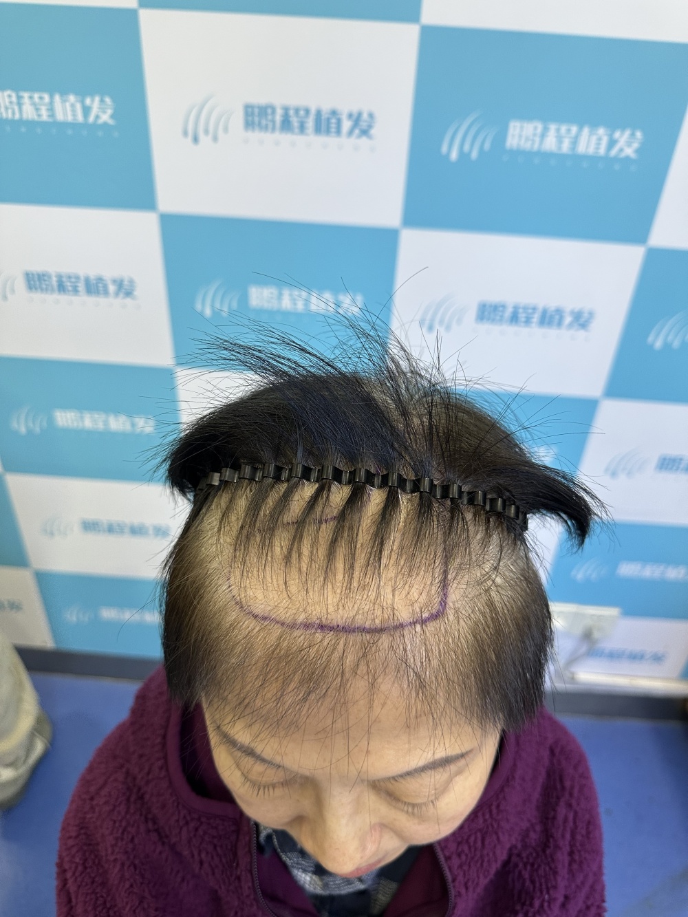 植髮全流程拆解