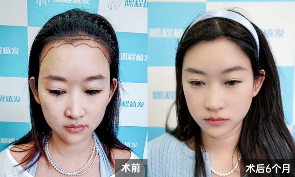 術後半年·原生感髮際線完美成型