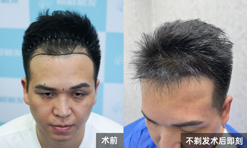 術後即時效果驚艷，