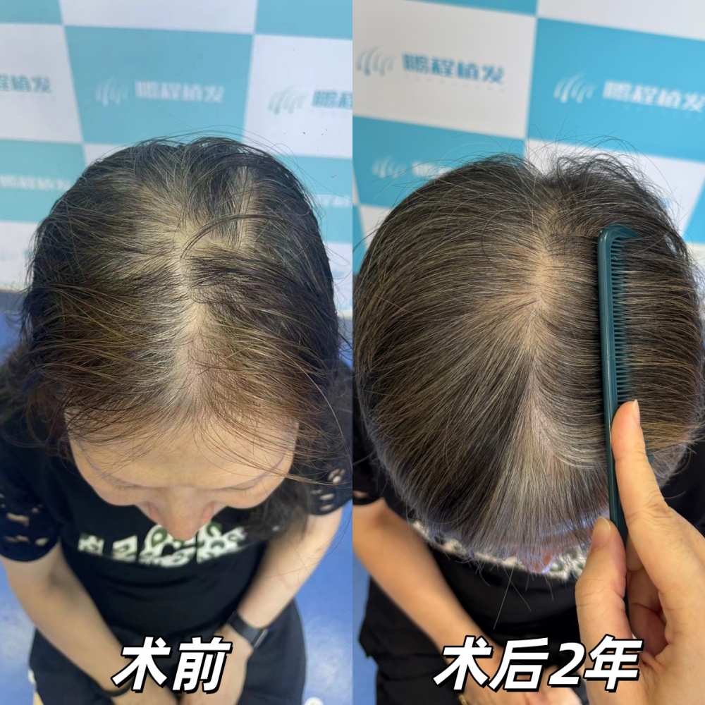 術後即刻到術後2年