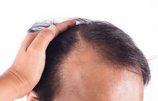 ⚠️植髮翻車仲有得救？香港髪友必睇！呢個黃金時機修復成功率高 90%