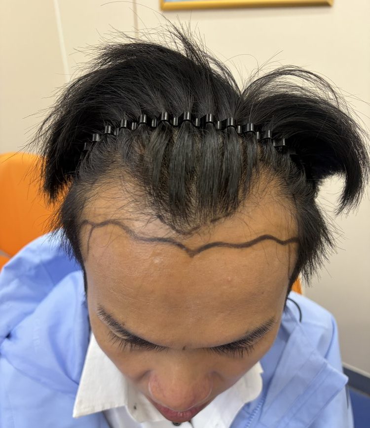 30-40 歲為何是植髮黃金期？香港脫髮人士必看｜深圳鵬程植髮醫院專業解析