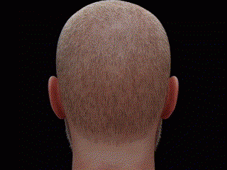 植髮後兩年狂脫？！香港朋友必睇植髮失敗真相 + 避坑全攻略