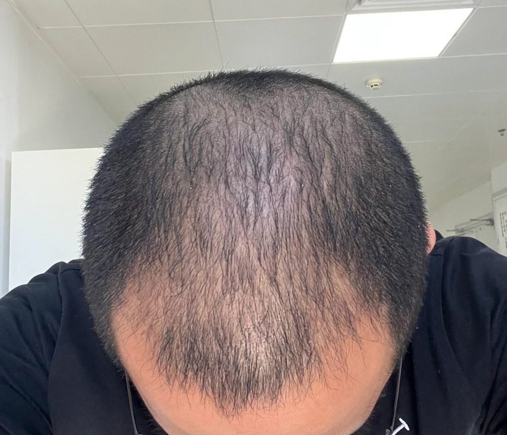 植髮失敗避坑｜做好 4 大术前準備，從源頭杜絕香港植髮效果差、毛囊存活率低