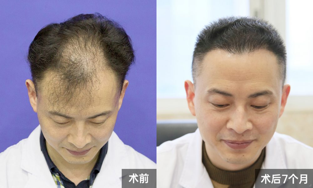 我院醫護人員植髮成功案例｜微針植髮修復髮際線+頭頂加密，7個月逆襲精神面貌