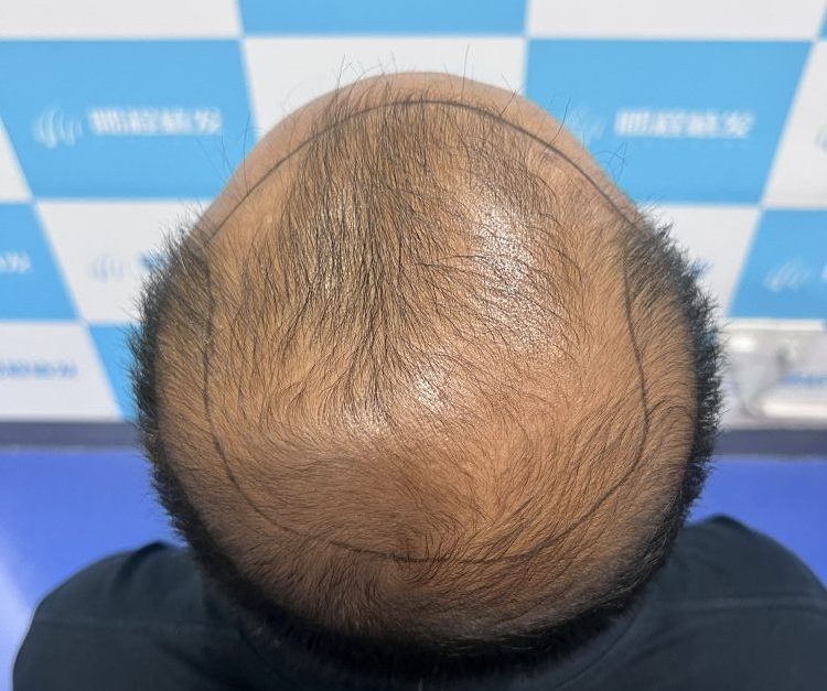 洗頭掉髮點算？香港髪友必睇脫髮真相｜深圳鵬程植髮教你科學自救
