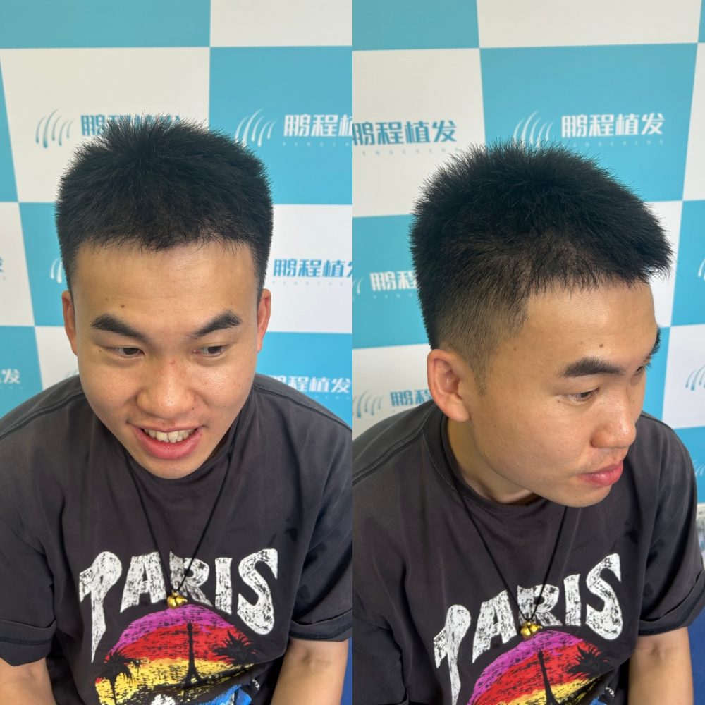 PST 微針植髮