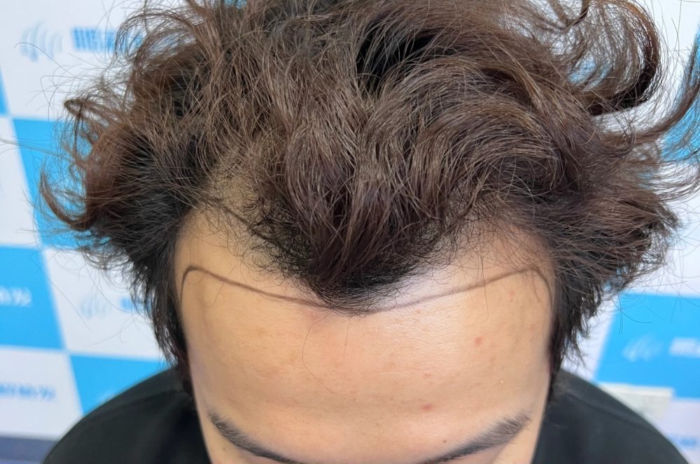 雄激素脫髮科學干預指南：從藥物到植髮，一步步守護香港髮友髮量