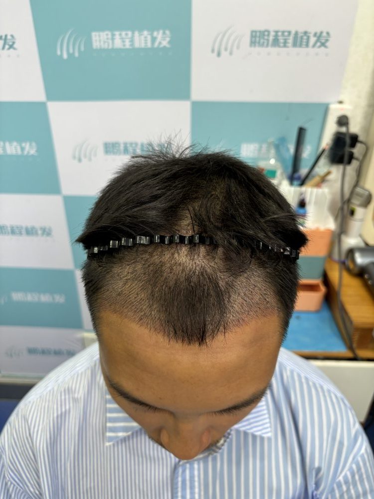 術後5天