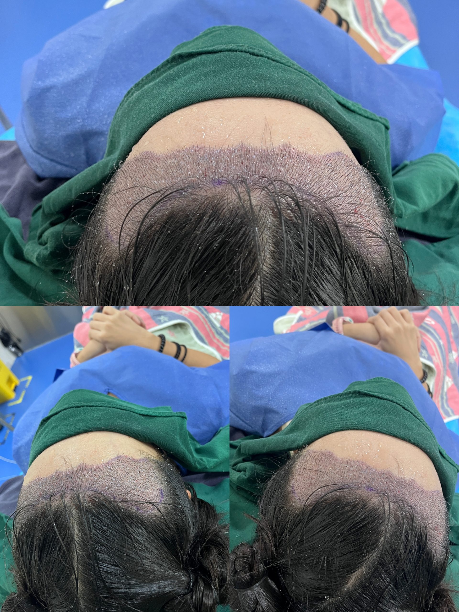 香港发友必睇：植髮最多做幾次？間隔要點一文講清