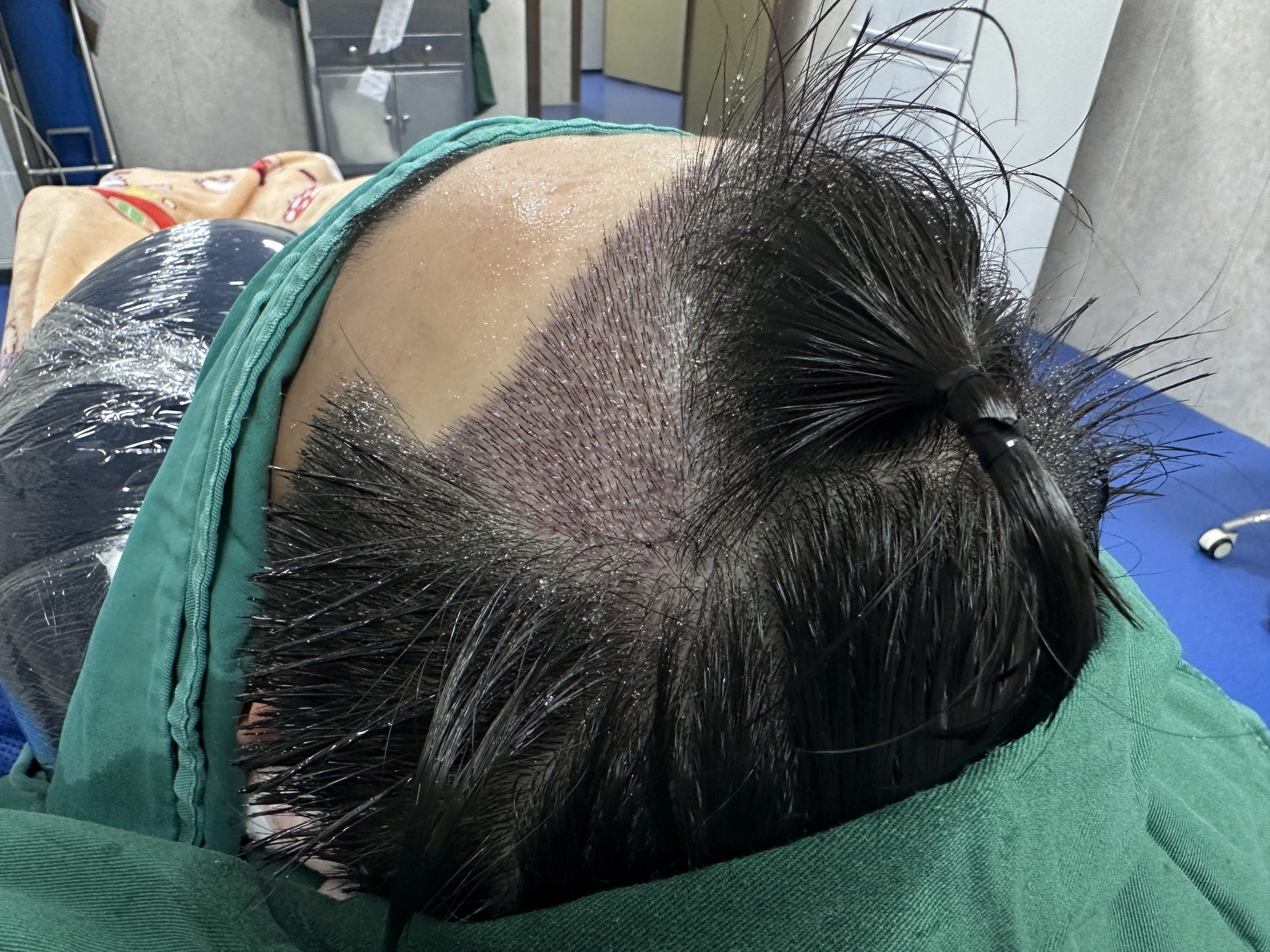 在深圳植髮後要唔要繼續用藥？答案就睇呢個關鍵點！