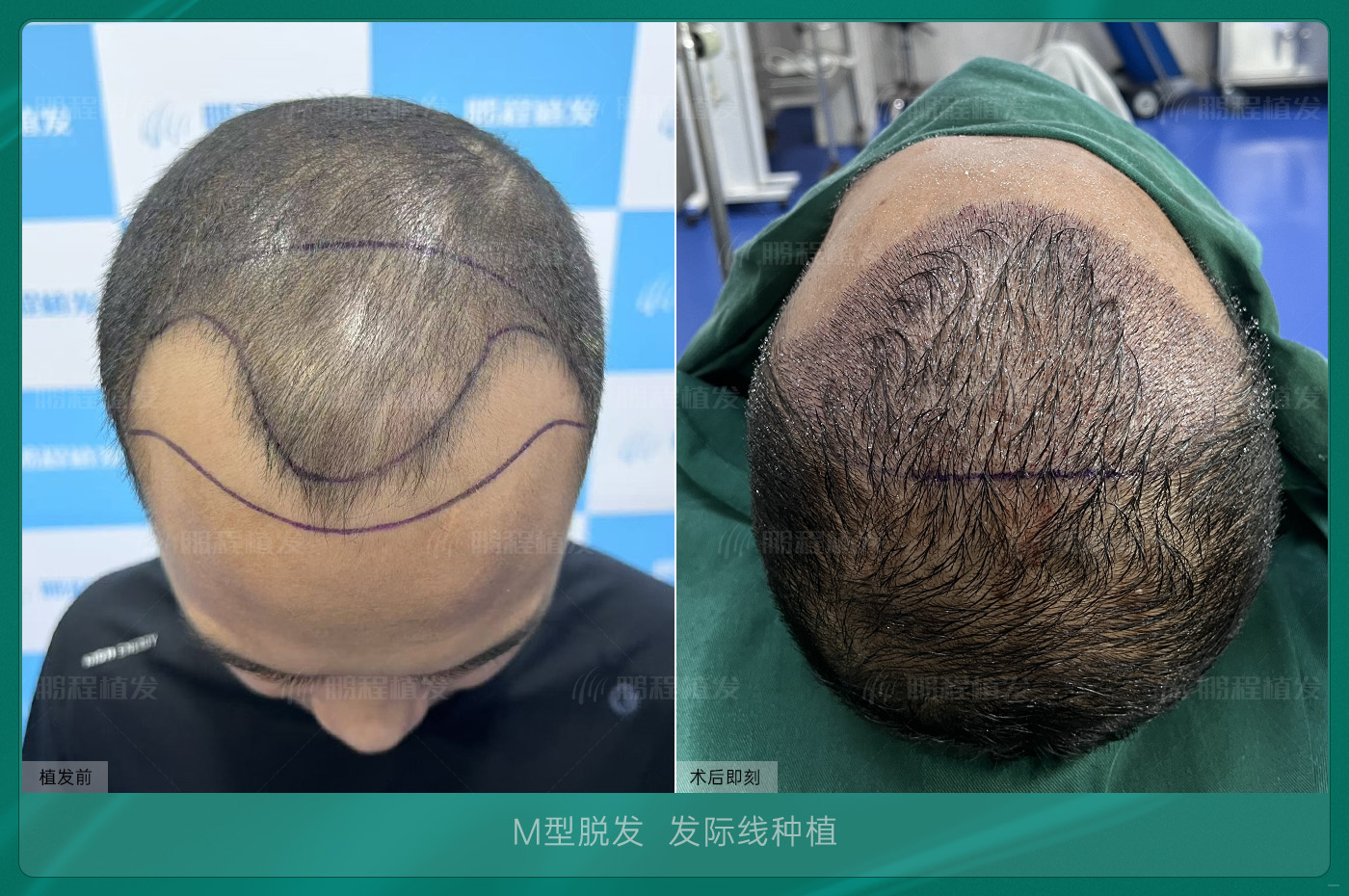 香港人植髮前總猶疑？呢 3 個顧慮，八成香港髮友都有過！