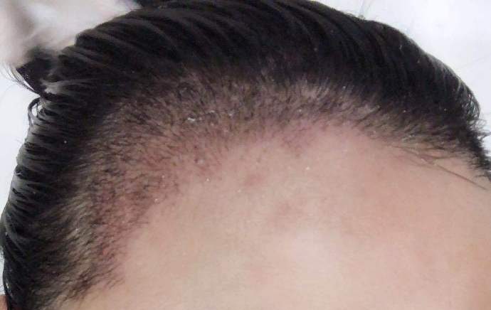 🔥植髮失敗唔使慌！香港人專屬修復攻略，9 成人都可以救返！