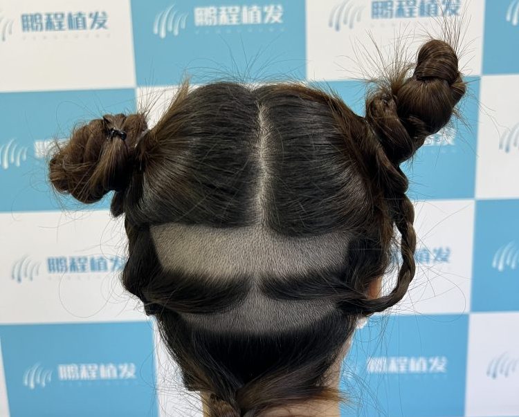 香港植髮選剃髮還是不剃髮？兩種方式區別大公開，幫你選對不踩坑