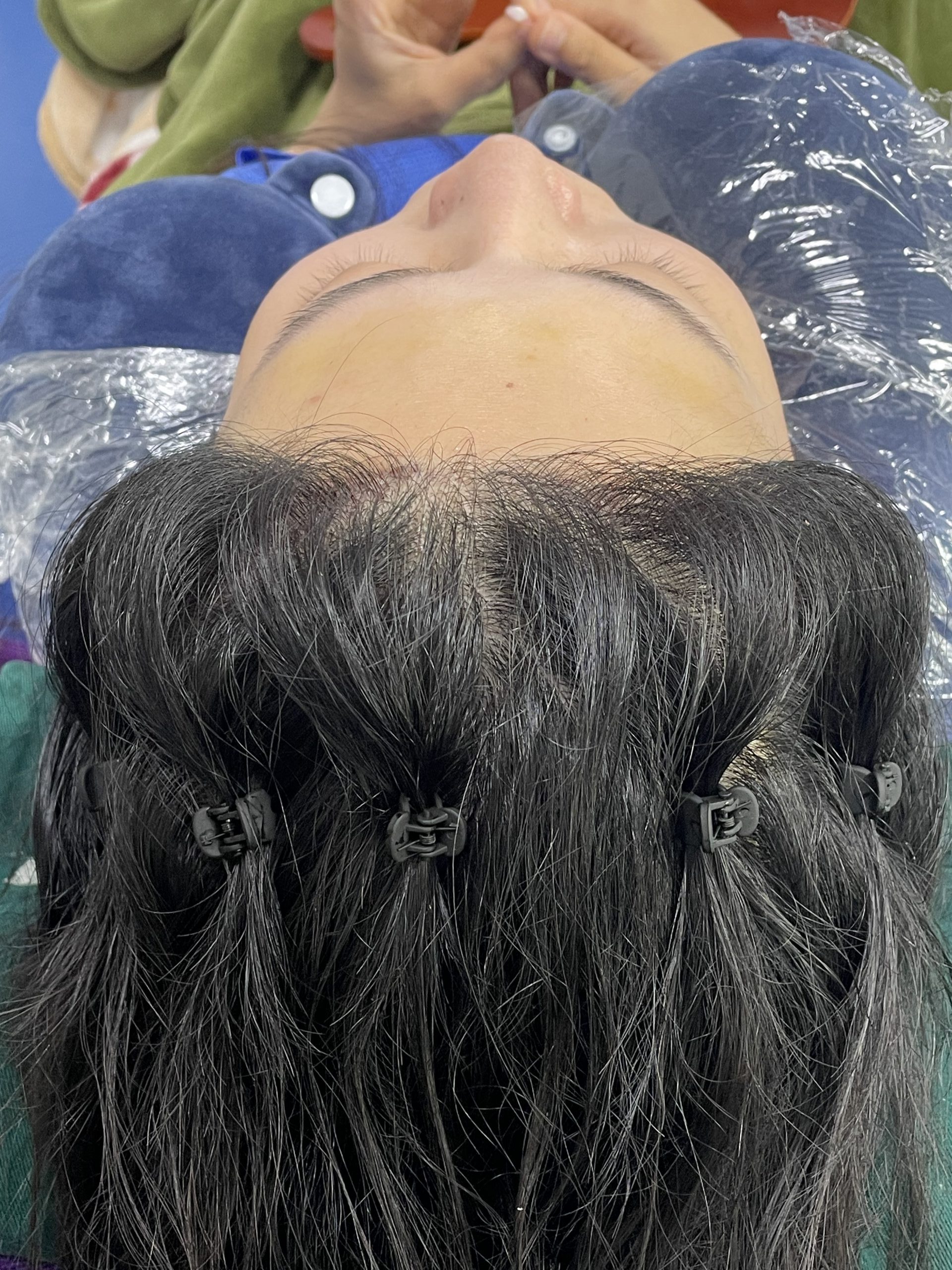 深圳植髮｜剃髮定不剃髮？香港人最關心嘅選擇攻略 + 4 類適配人群解析