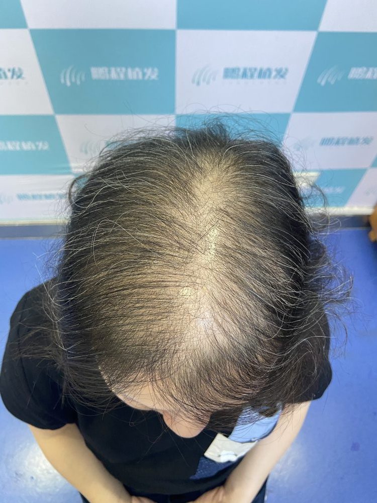 脂溢性脫髮
