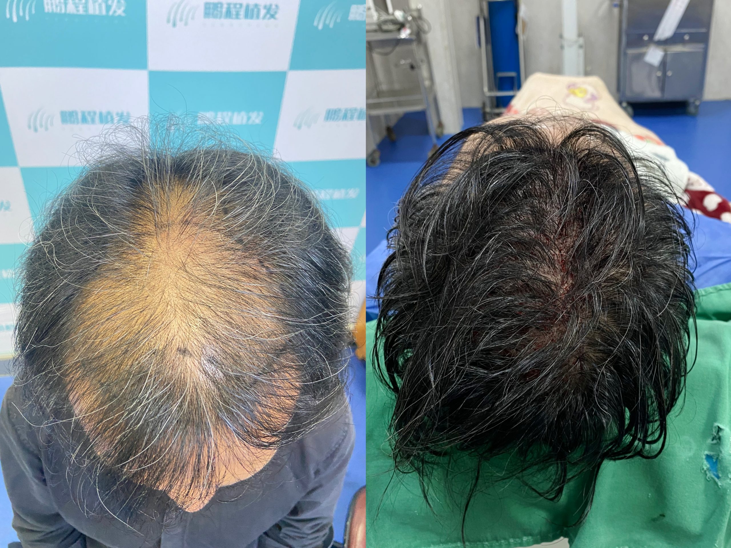 香港發友唔使愁！地中海脫髮有得救？植髮適配全攻略