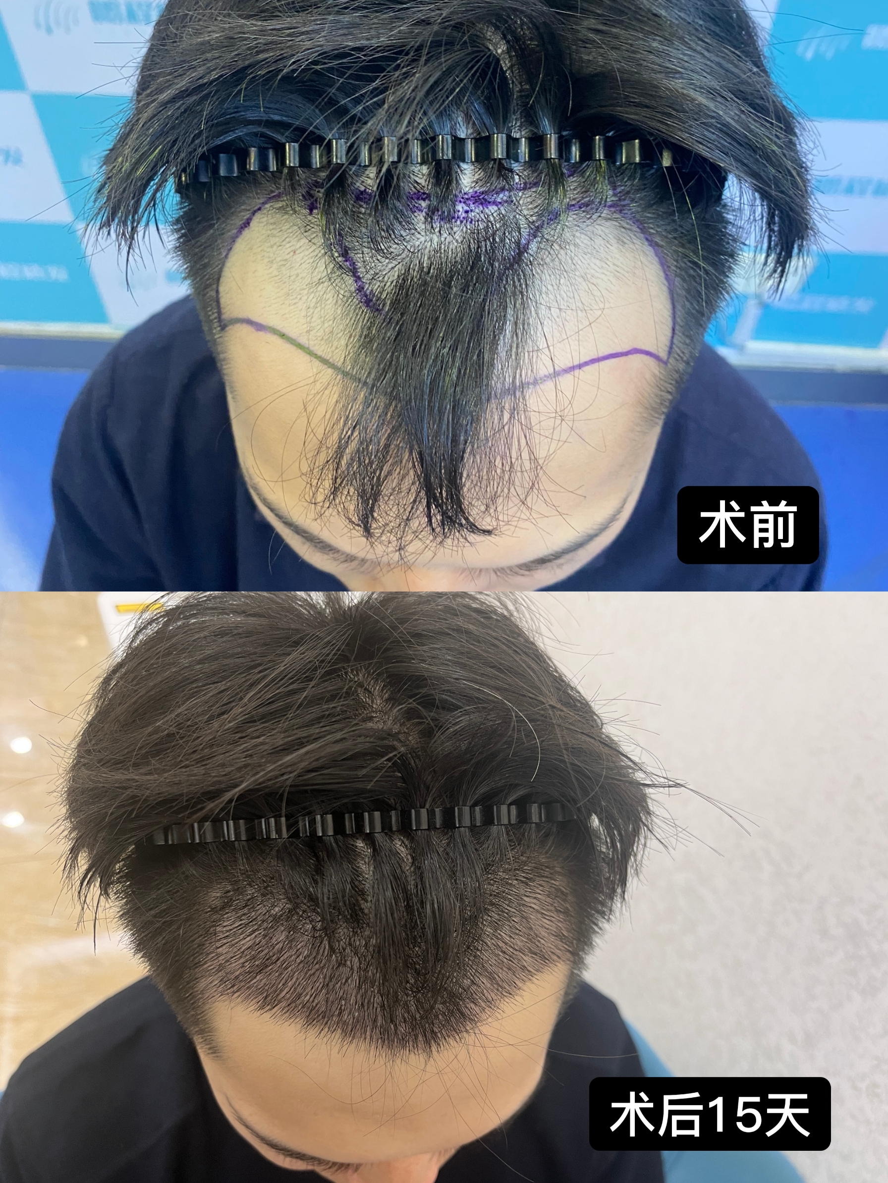 香港髮友必看！M 型脫髮顯「貓耳朵」？改善思路 + 治療方案大公開