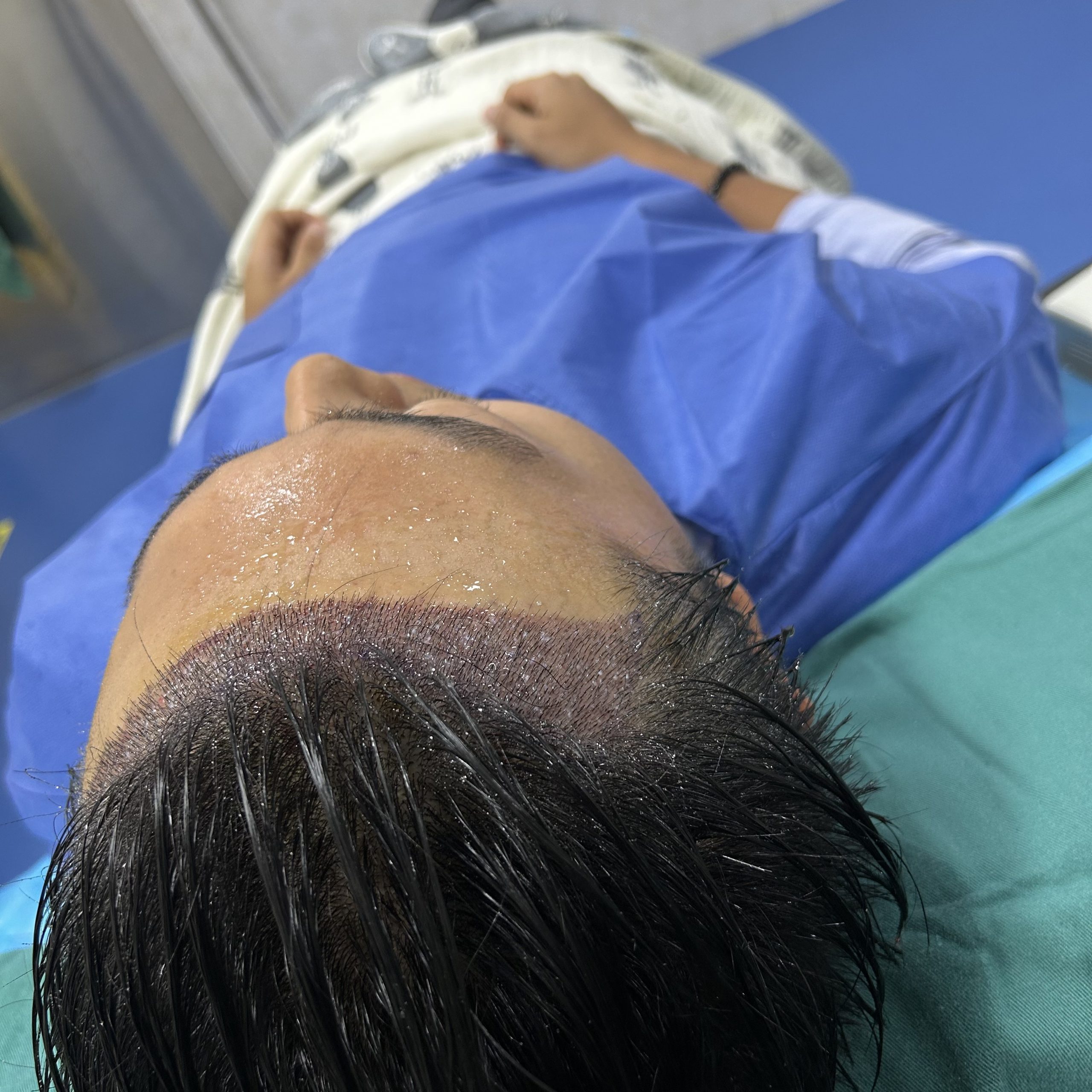 香港發友速睇！植髮 4 大「人間清醒」誤區 一次搞掂唔踩坑