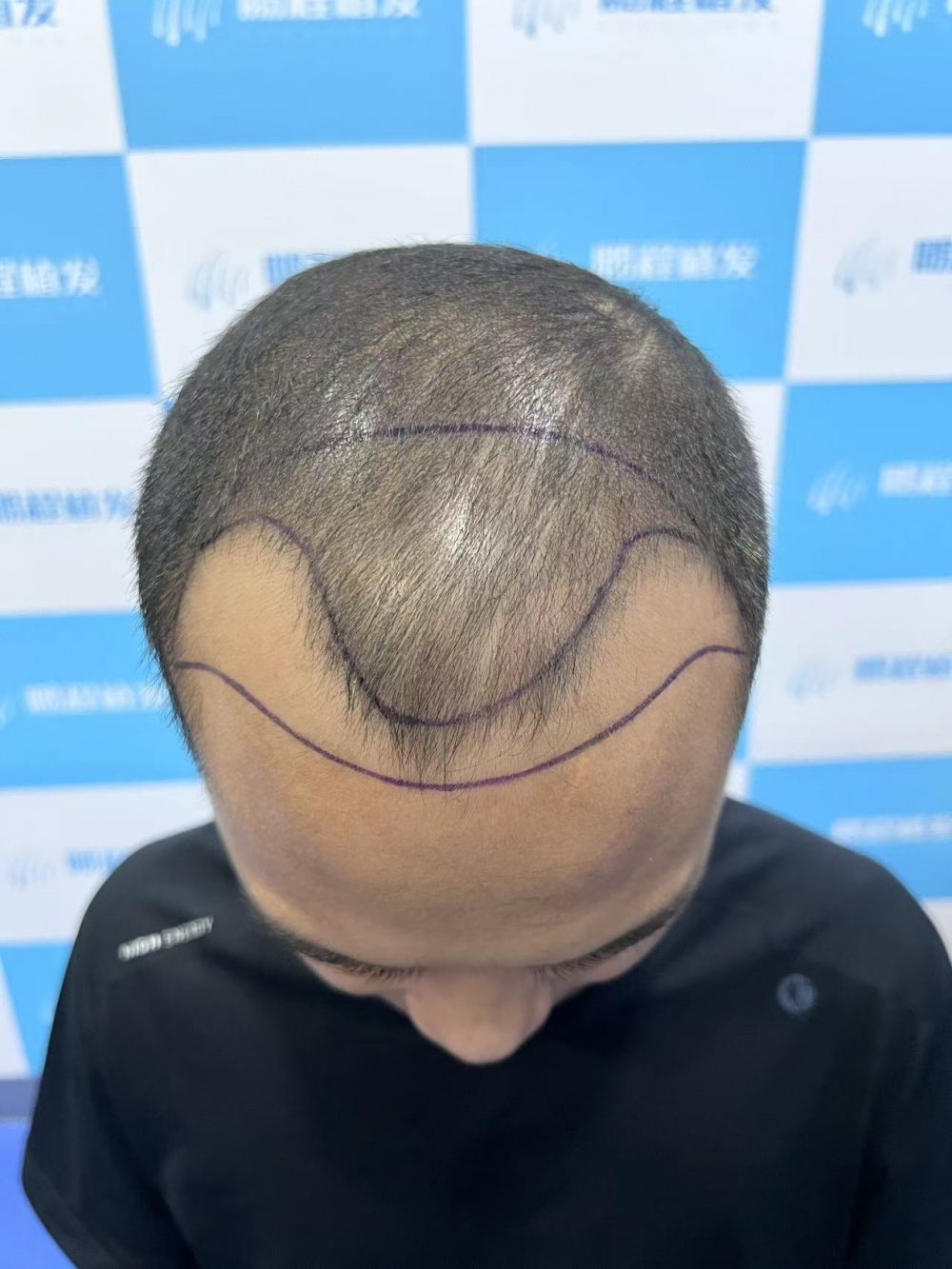 发际线设计