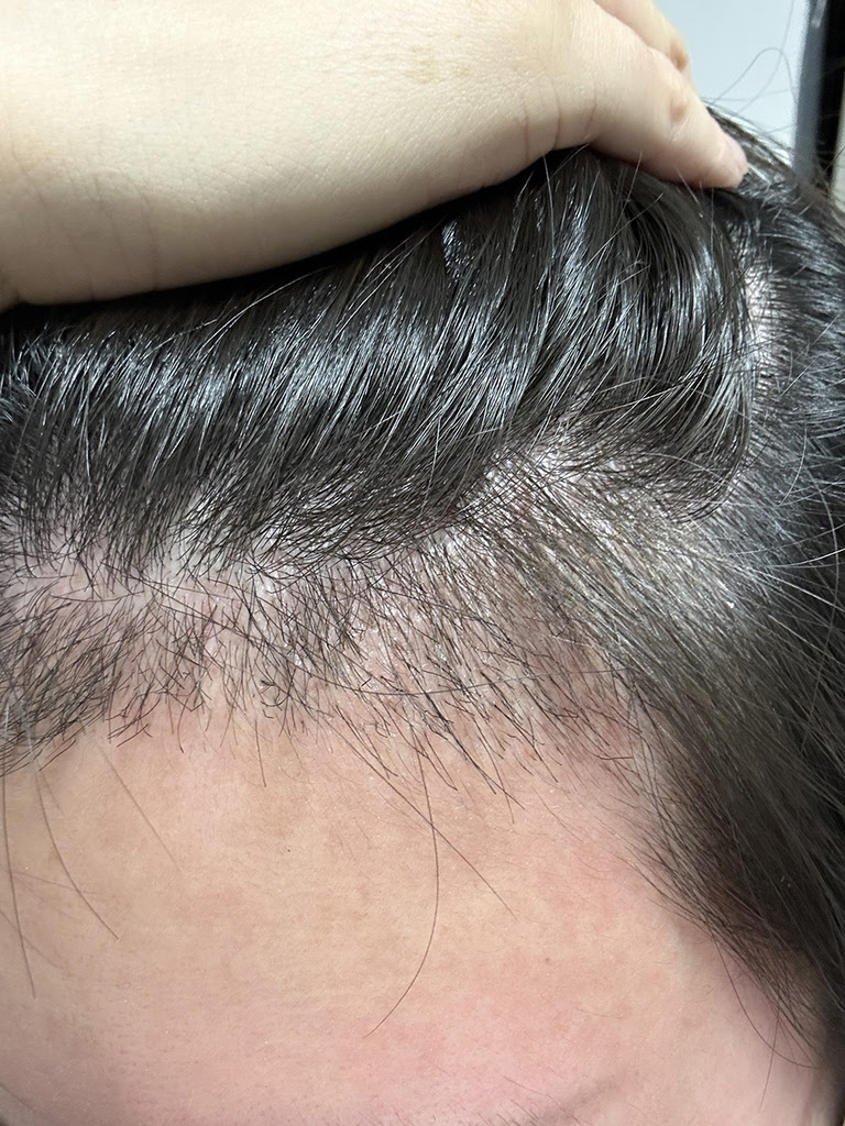 唔使驚！植髮後頭髮又甩？深圳鹏程醫院拆解迷思