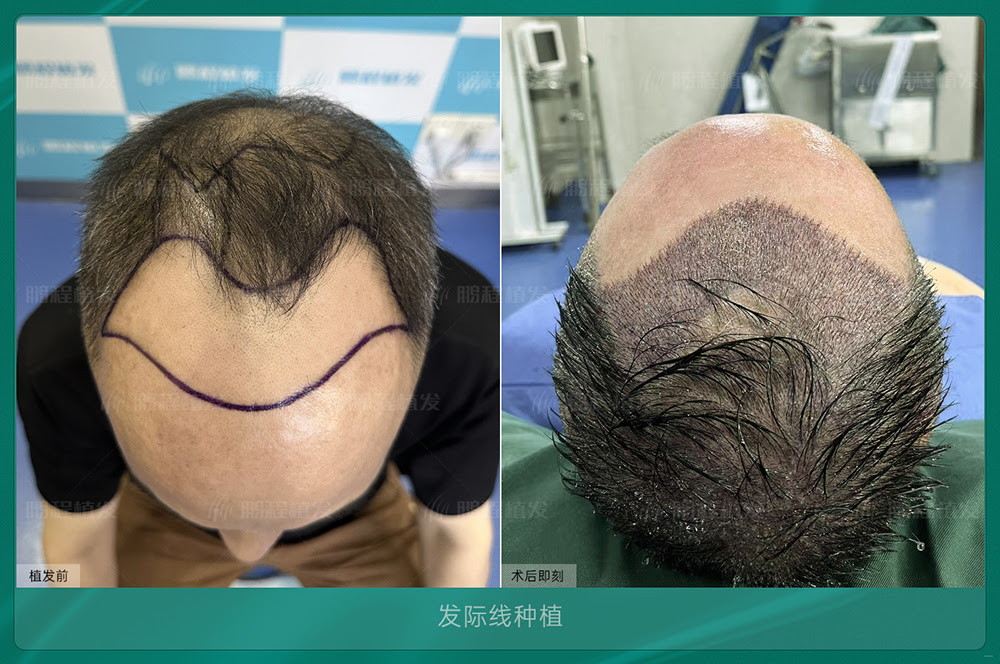 植髮價差萬幾？理性睇價錢背後真相｜內行人拆解