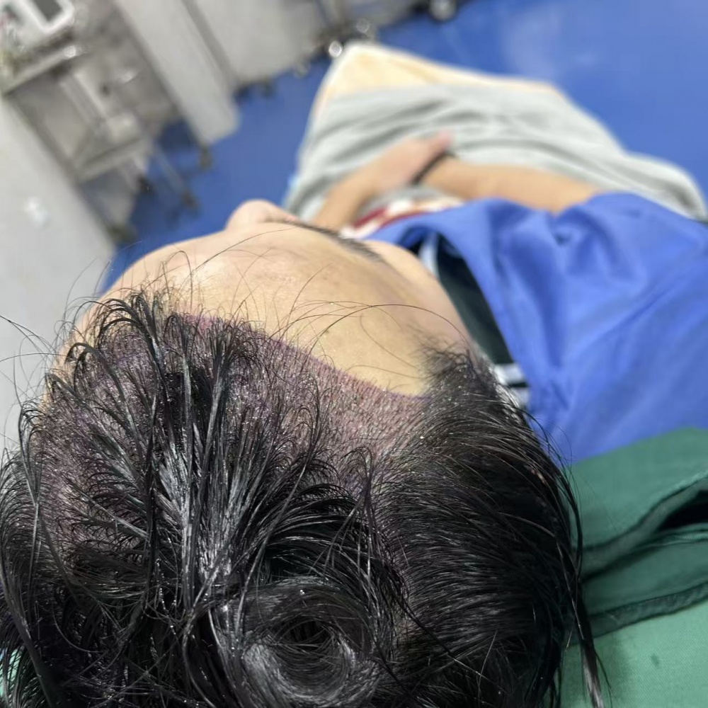 植发效果