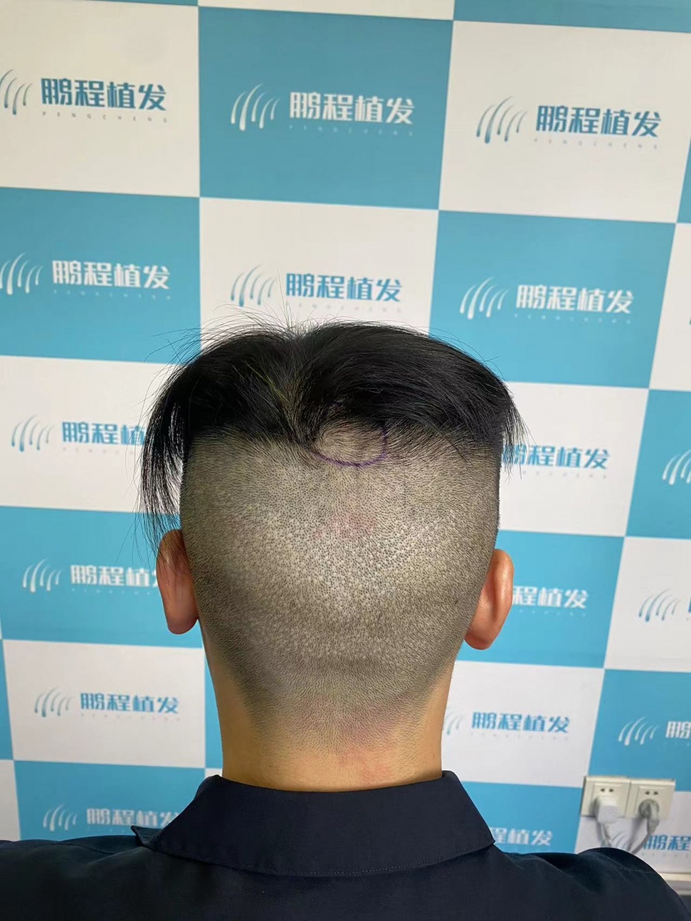 后枕部