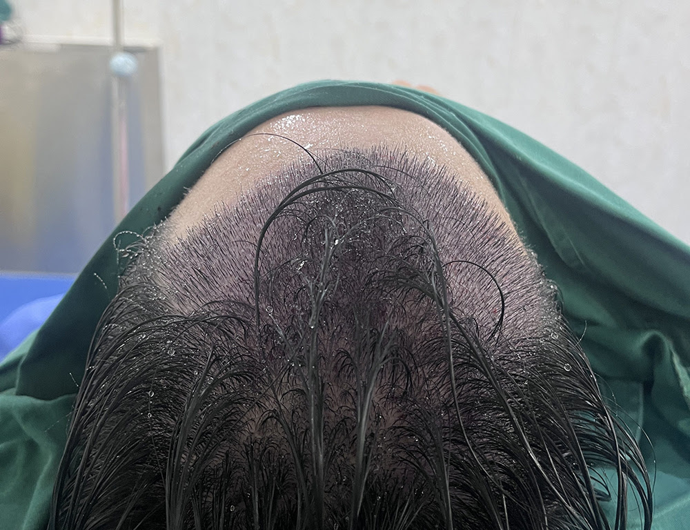 揭秘｜鵬程微針植髮：新頭髮自然到似天生？關鍵係呢點​