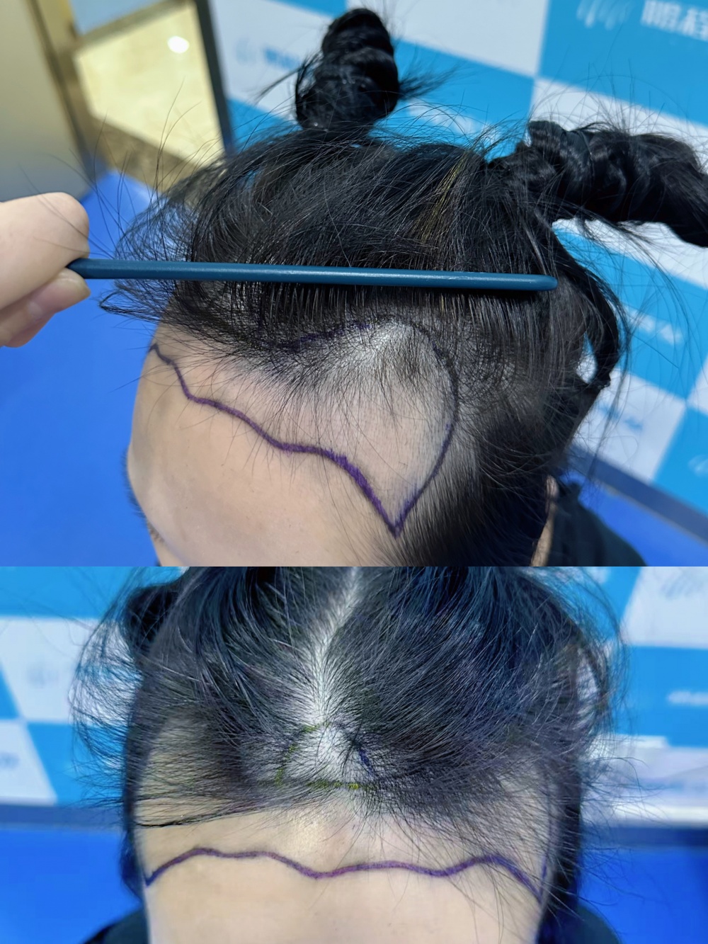 术前设计