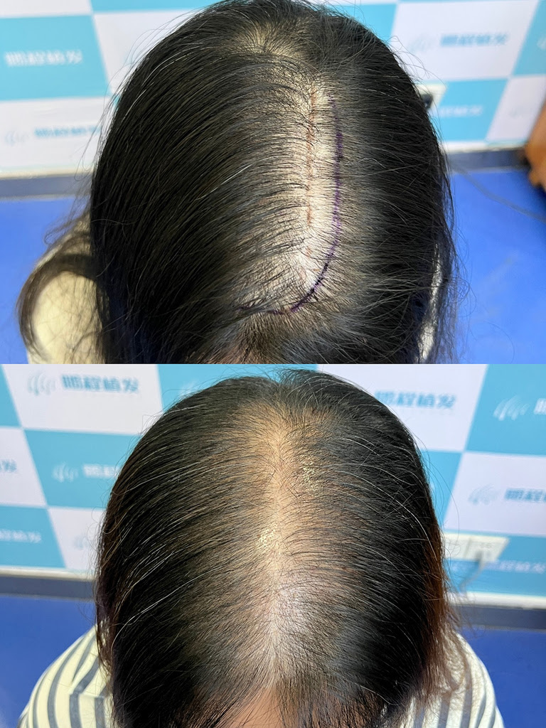 植髮有年齡限制嗎？香港人必睇完整指南