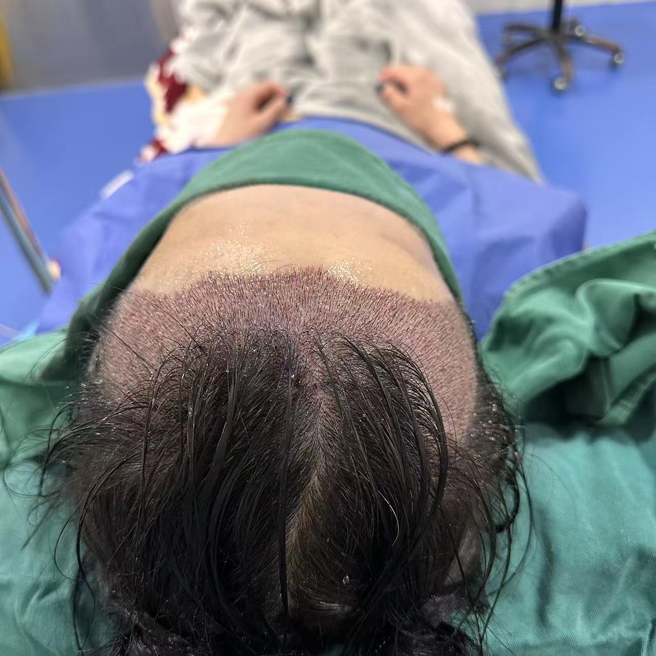 植髮穩住唔反車！3大核心環節，從頭擁有靚髮