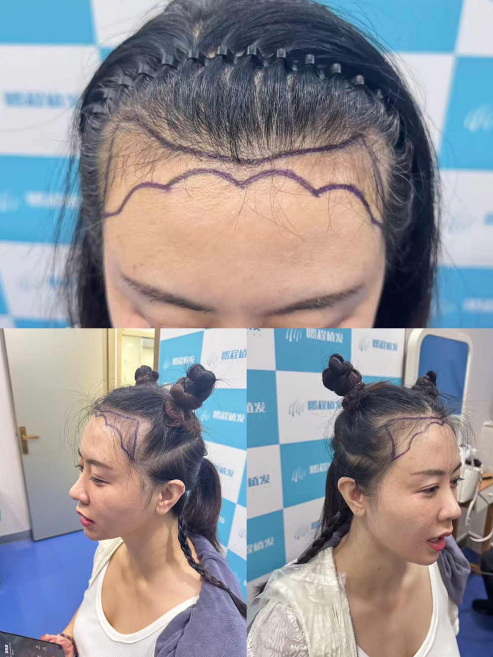 术前设计