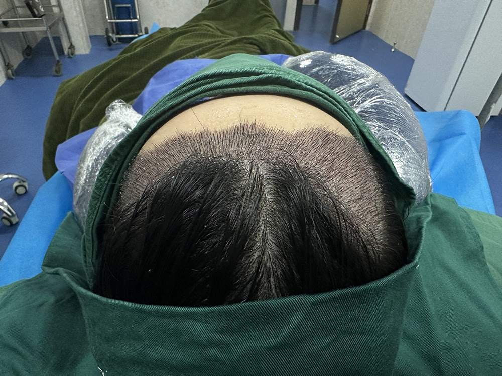 香港髮友必睇｜植髮預算唔夠？少植一啲得唔得？醫生話咁講