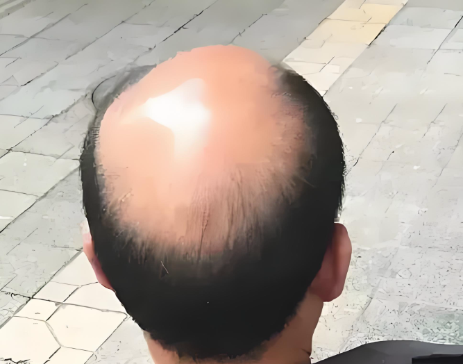 香港髮友問｜脫髮嚴重剃光頭？真相同你講清！
