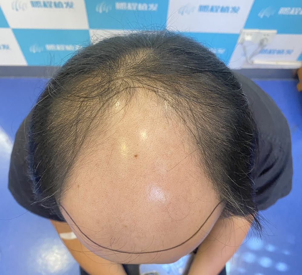 聰明絕頂有根據？香港髮友必看！M 型 / O 型脫髮成因大公開｜深圳鵬程植髮