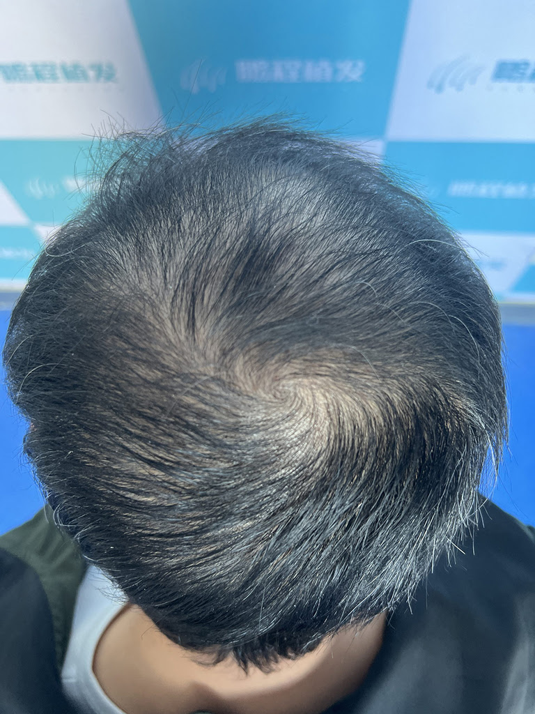 深圳植髮後恢復期要幾耐？完整時間表公開