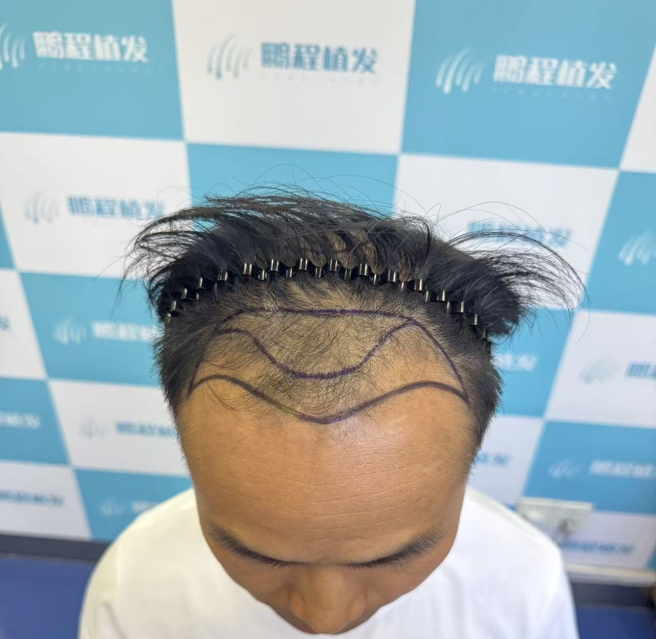 香港髮友深圳植髮指南：一次實現理想效果的秘訣