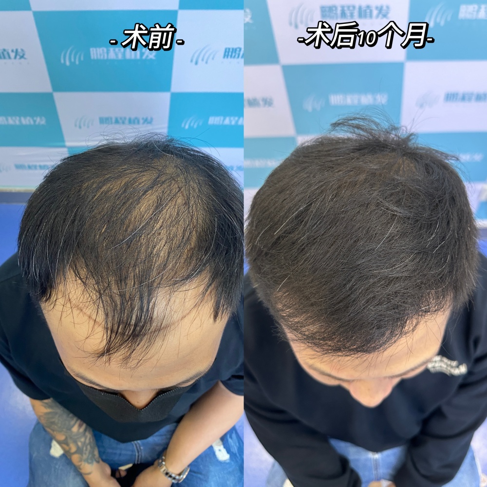 雄激素性脱发种植效果