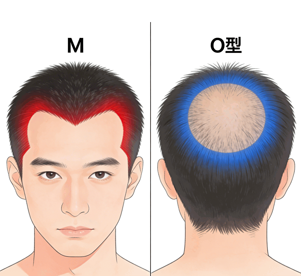 香港髮友注意！脫髮M型/O型點應對？深圳鵬城醫院教你一招搞定