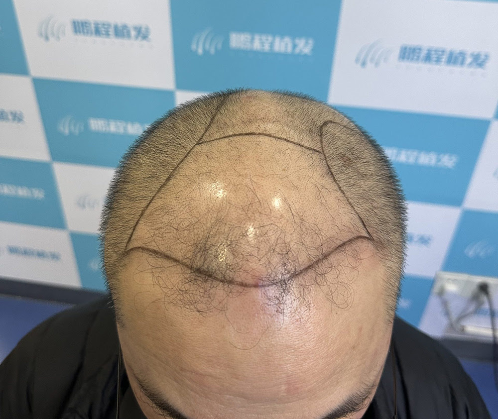 香港髮友深圳植髮｜毛囊單位點估算？一文睇清