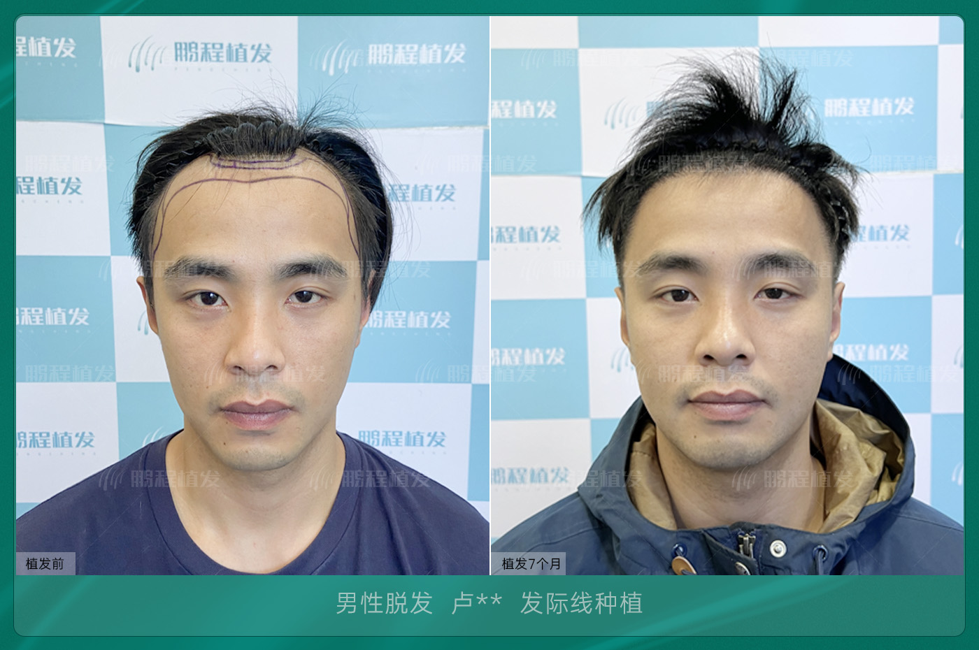 香港髮友髮際線後移點治療？先天後天方案大不同！