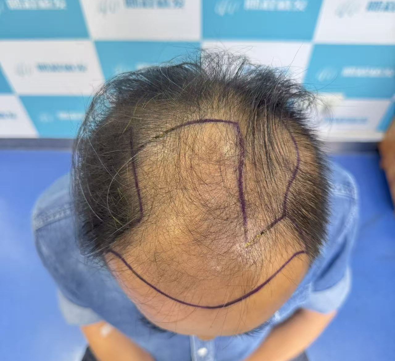 香港髮友勿等「禿」咗先植髮！最佳時機+早期干預全攻略