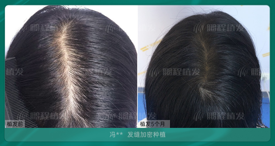 髮縫稀疏擴大、頭皮外露？香港髮友必看改善全攻略（早干预少花錢）