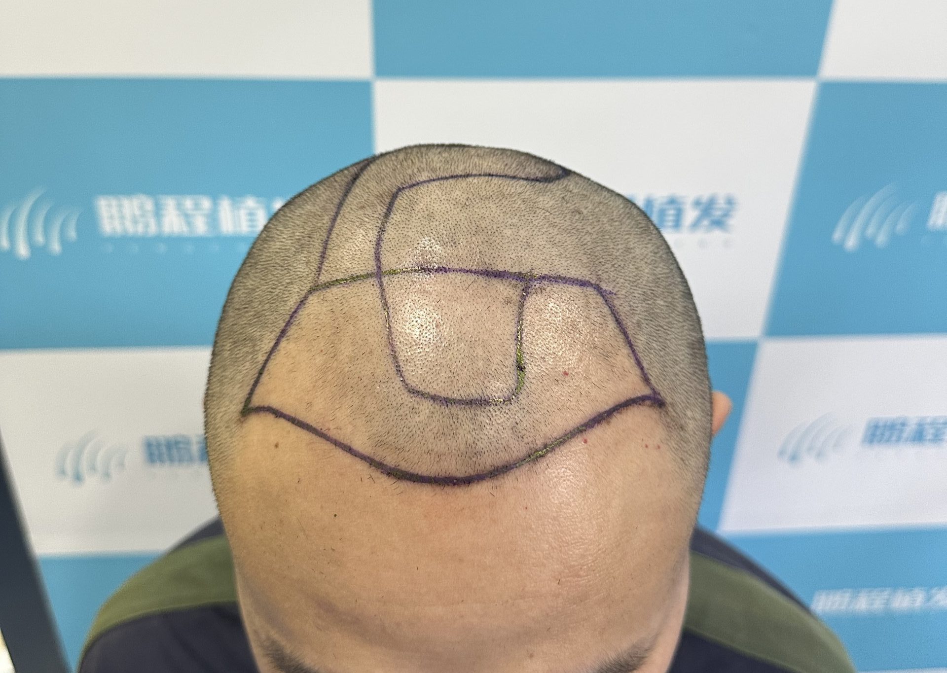 香港髮友深圳植髮必看｜毛囊需求科學估算指南（附常見範圍參考）